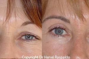 Eyelid surgery photos - Blepharoplasty