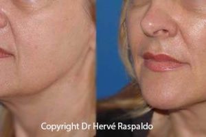 Photos of hyaluronic acid injections to treat wrinkles and volumes