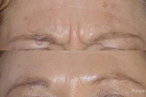 Photos of botulinum toxin and botox injections to treat wrinkles