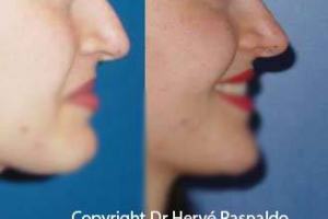 Nose surgery photos - surgical rhinoplasty and medical rhinoplasty