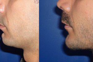 Genioplasty photos to correct the chin