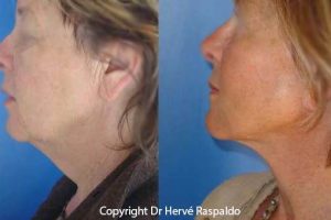 Face lift and neck lift photos