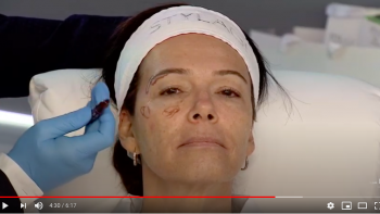analyse du visage avant injections et facesculpture