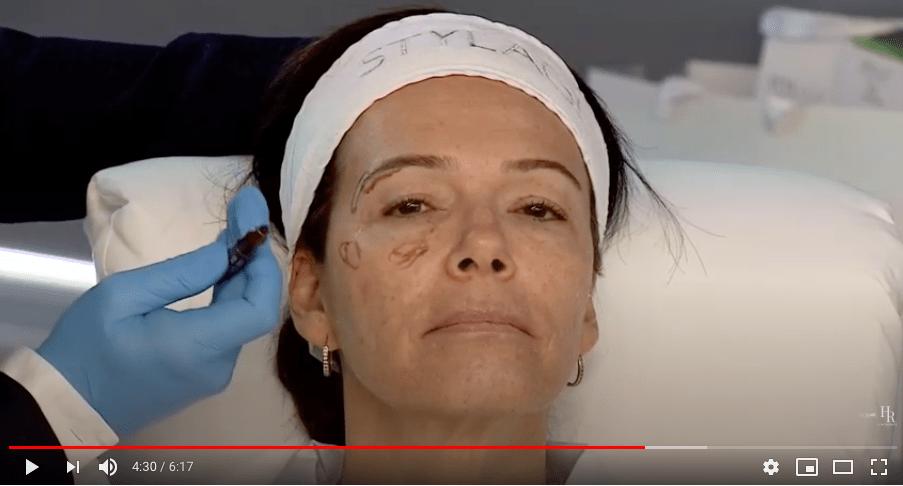 analyse du visage avant injections et facesculpture