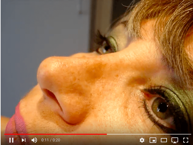 opération du nez plastie narinaire
