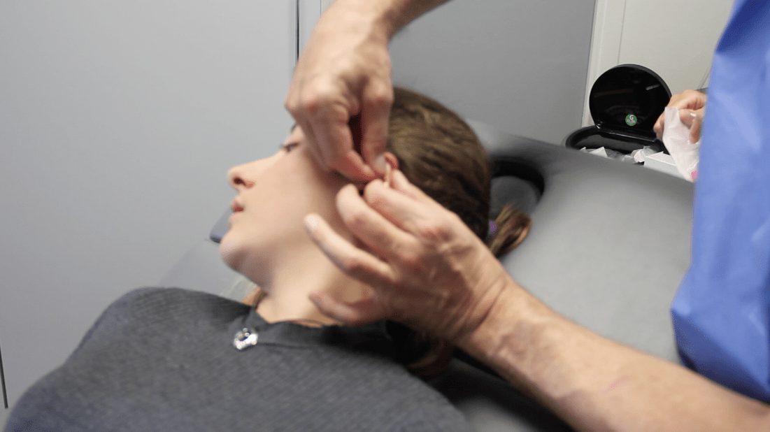 essai avant implant earfold pour recoller les oreilles