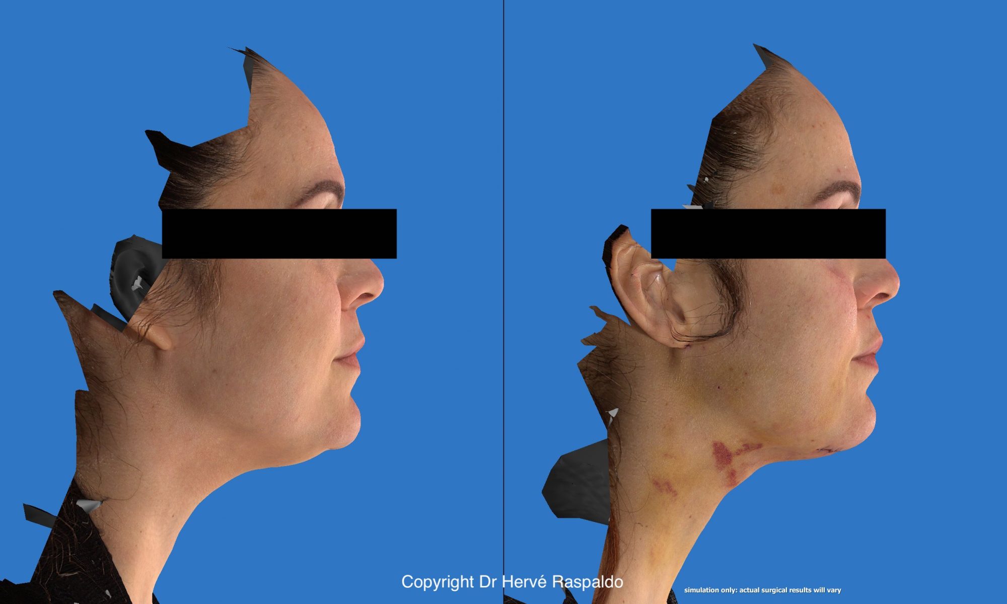 chirurgie du cou et du menton vue de profil