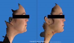chirurgie du cou et du menton vue de profil