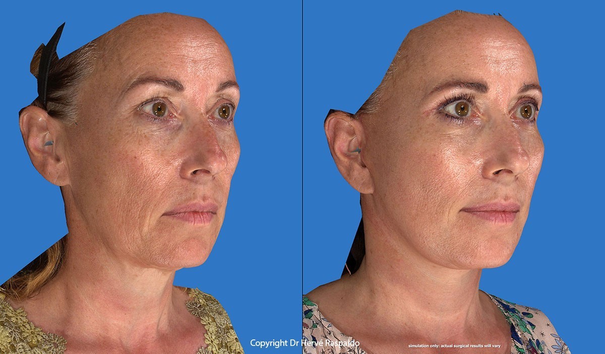 lifting endoscopique photo profil raspaldo genève lifting endoscopique profil raspaldo genève
