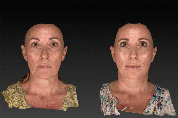 résultat lifting endoscopique visage