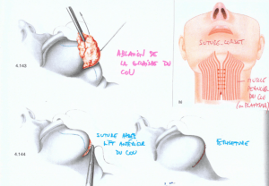 techniques pour un lifting du cou