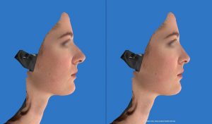 morphing 2D rhinoplastie