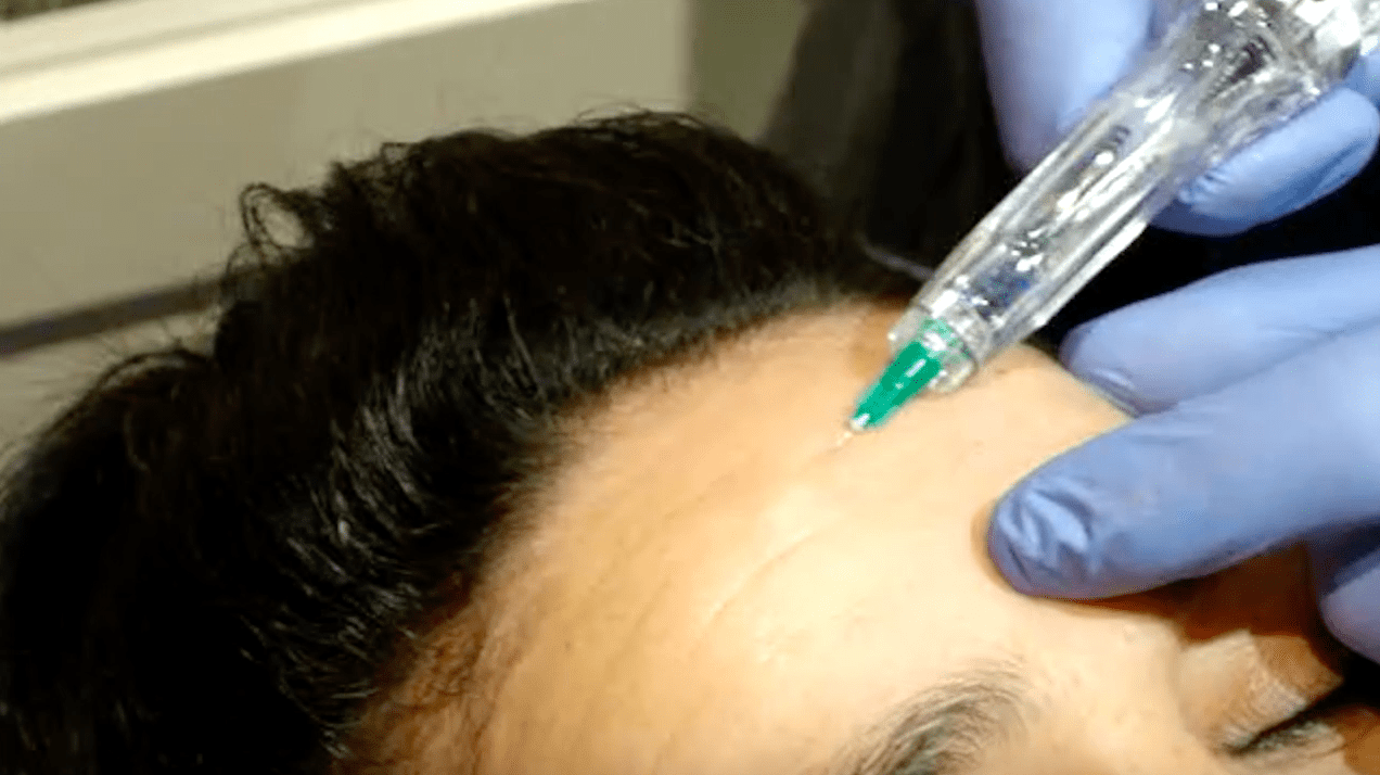 injections mésothérapie dans la peau