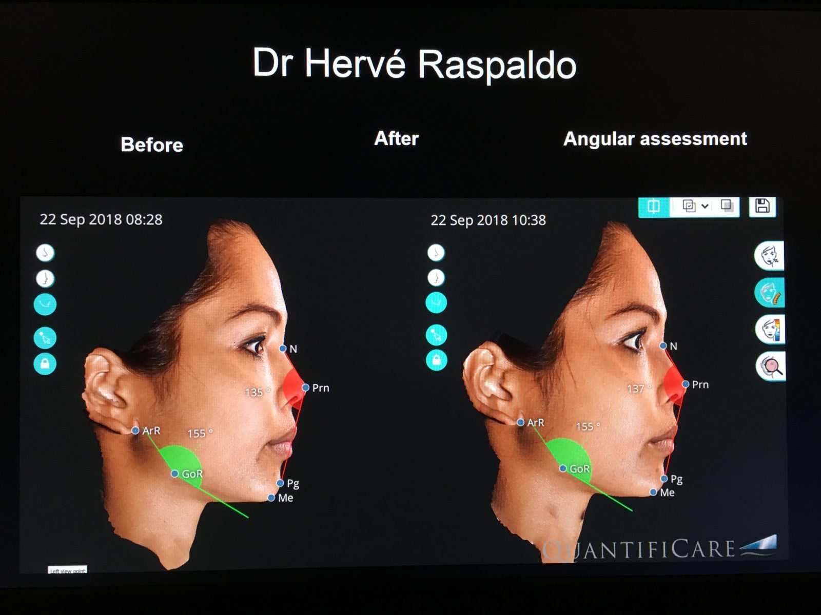 injections nez asiatique rhinoplastie