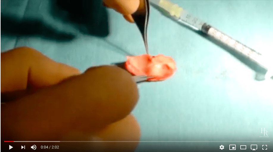 rhinoplastie du nez par greffe de cartilage