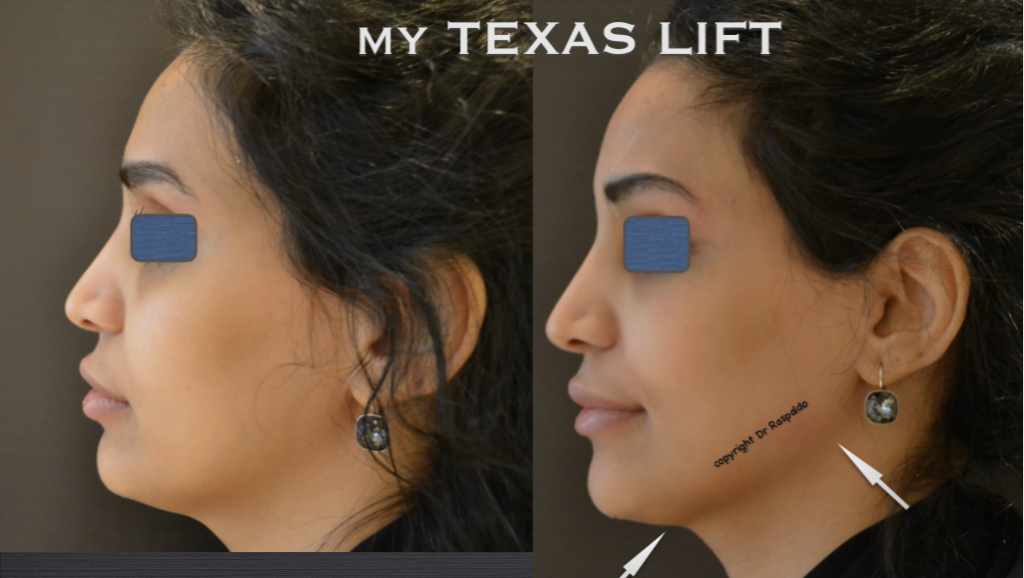 Hyaluronic Acid for facial contouring Dr Raspaldo, Face and Neck surgeon